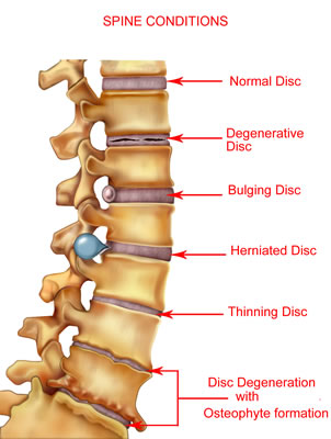 A Picture of various spine condtions such as herniated disc and degenerative disc