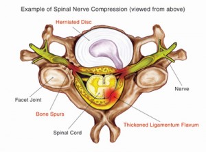 nerve-compression